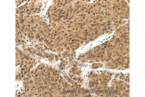 Immunohistochemistry of Human liver cancer using TERF2 Polyclonal Antibody at dilution of 1:30 (TRF2 antibody)