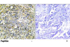 Immunohistochemistry analysis of paraffin-embedded human lung carcinoma tissue using UBXN11 polyclonal antibody .