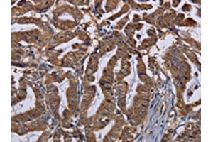 The image on the left is immunohistochemistry of paraffin-embedded Human esophagus cancer tissue using ABIN7130206(MCTS1 Antibody) at dilution 1/30, on the right is treated with fusion protein. (MCTS1 antibody)