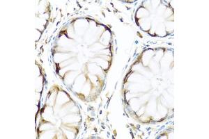 Immunohistochemistry of paraffin-embedded human colon using APCS antibody (ABIN5971040) at dilution of 1/100 (40x lens). (APCS antibody)