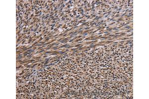 Immunohistochemistry of Human breast cancer using KIF2A Polyclonal Antibody at dilution of 1:30 (KIF2A antibody)