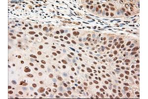 Immunohistochemical staining of paraffin-embedded Adenocarcinoma of breast using anti-NTF4 (ABIN2452547) mouse monoclonal antibody. (Neurotrophin 4 antibody  (AA 81-210))