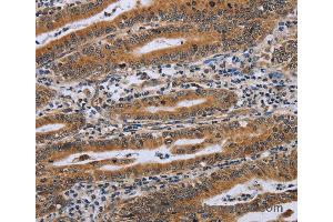 Immunohistochemistry of Human gastric cancer using NDUFAF4 Polyclonal Antibody at dilution of 1:45