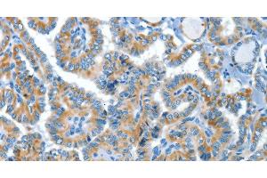 Immunohistochemistry of paraffin-embedded Human thyroid cancer tissue using COG1 Polyclonal Antibody at dilution 1:60 (COG1 antibody)