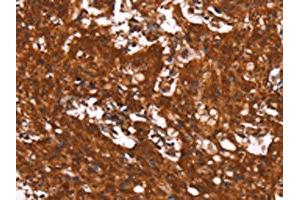 The image on the left is immunohistochemistry of paraffin-embedded Human gastic cancer tissue using ABIN7190910(HCAR2 Antibody) at dilution 1/40, on the right is treated with synthetic peptide.