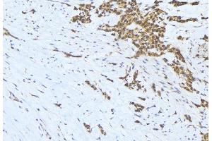 ABIN6275653 at 1/100 staining Human lung cancer tissue by IHC-P. (USP19 antibody  (Internal Region))