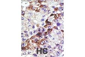 Formalin-fixed and paraffin-embedded human cancer tissue reacted with the primary antibody, which was peroxidase-conjugated to the secondary antibody, followed by AEC staining. (UBE2E3 antibody  (N-Term))