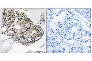 Immunohistochemistry analysis of paraffin-embedded human breast carcinoma tissue using RPS25 antibody. (RPS25 antibody  (C-Term))
