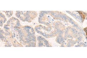 Immunohistochemistry of paraffin-embedded Human thyroid cancer tissue using COG4 Polyclonal Antibody at dilution of 1:30(x200) (COG4 antibody)