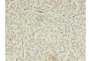 Immunohistochemistry of paraffin-embedded human breast cancer using ABIN7151851 at dilution of 1:100 (EPH Receptor A7 antibody  (AA 28-182))