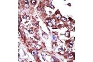 Formalin-fixed and paraffin-embedded human cancer tissue reacted with the primary antibody, which was peroxidase-conjugated to the secondary antibody, followed by AEC staining. (NME7 antibody  (N-Term))