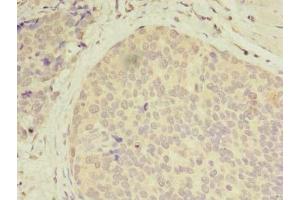 Immunohistochemistry of paraffin-embedded human gastric cancer using ABIN7146141 at dilution of 1:100 (CXCL6 antibody  (AA 38-114))