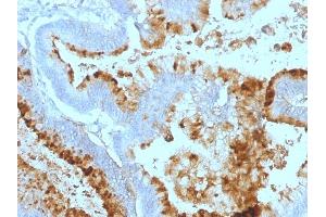 Formalin-fixed, paraffin-embedded human Colon Carcinoma stained with Lewis A Monoclonal Antibody (7LE). (Blood Group Lewis A antibody)