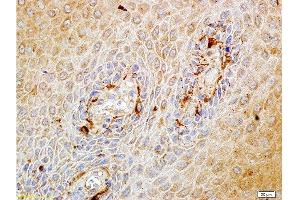 Formalin-fixed and paraffin embedded human endometrium carcinoma labeled with Rabbit Anti-Matriptase Polyclonal Antibody, Unconjugated at 1:100 followed by conjugation to the secondary antibody and DAB staining. (ST14 antibody  (AA 11-100))
