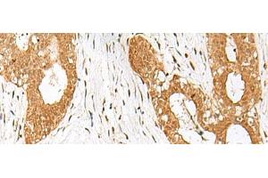 Immunohistochemistry of paraffin-embedded Human breast cancer tissue using IPO11 Polyclonal Antibody at dilution of 1:70(x200) (Importin 11 antibody)