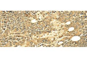 Immunohistochemistry of paraffin-embedded Human ovarian cancer using ECE2 Polyclonal Antibody at dilution of 1/25 (ECE2 antibody)