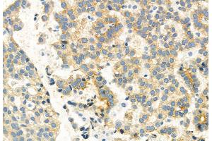 ABIN6261462 and ABIN6269075 at 1/100 staining Human lung cancer by IHC-P. (EGFR antibody  (C-Term))