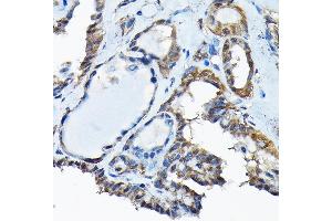 Immunohistochemistry of paraffin-embedded human thyroid cancer using RBBP9 Rabbit pAb (ABIN6129095, ABIN6146752, ABIN6146753 and ABIN6220638) at dilution of 1:200 (40x lens). (RBBP9 antibody  (AA 1-186))