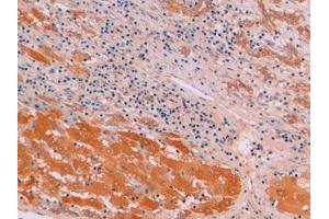 Detection of β-catenin in Human Liver cancer Tissue using Monoclonal Antibody to Beta Catenin (β-catenin) (beta Catenin antibody  (AA 439-675))