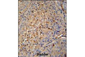 MAPRE1 antibody immunohistochemistry analysis in formalin fixed and paraffin embedded human bladder carcinoma followed by peroxidase conjugation of the secondary antibody and DAB staining. (MAPRE1 antibody  (N-Term))