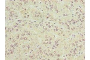 Immunohistochemistry of paraffin-embedded human liver cancer using ABIN7147940 at dilution of 1:100 (CIPC/KIAA1737 antibody  (AA 1-399))