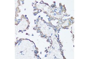 Immunohistochemistry of paraffin-embedded human lung cancer using Src antibody (ABIN6132240, ABIN6148428, ABIN6148429 and ABIN6215399) at dilution of 1:100 (40x lens). (Src antibody  (AA 1-80))