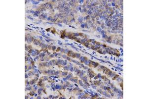Immunohistochemistry of paraffin-embedded human thyroid cancer using SNCG antibody (ABIN5971355) at dilution of 1/200 (40x lens). (SNCG antibody)