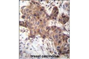 GDF9 Antibody (N-term) (ABIN656116 and ABIN2845455) immunohistochemistry analysis in formalin fixed and paraffin embedded human breast carcinoma followed by peroxidase conjugation of the secondary antibody and DAB staining. (GDF9 antibody  (N-Term))