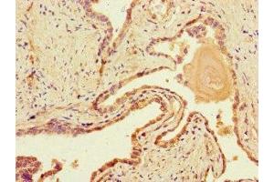 Immunohistochemistry of paraffin-embedded human prostate cancer using ABIN7150861 at dilution of 1:100