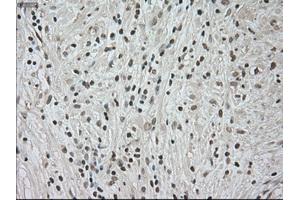 Immunohistochemical staining of paraffin-embedded Carcinoma of kidney tissue using anti-NTRK3mouse monoclonal antibody. (NTRK3 antibody)