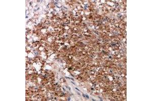 Immunohistochemical analysis of Vimentin staining in human breast cancer formalin fixed paraffin embedded tissue section.