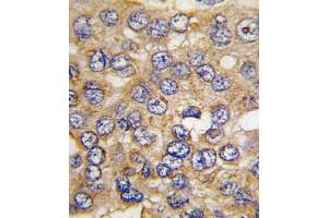Formalin-fixed and paraffin-embedded human hepatocarcinoma tissue reacted with PFKFB4 antibody , which was peroxidase-conjugated to the secondary antibody, followed by DAB staining.