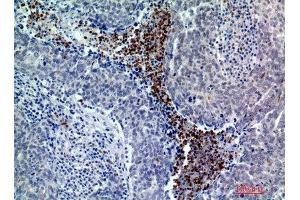 Immunohistochemistry (IHC) analysis of paraffin-embedded Human Breast Cancer, antibody was diluted at 1:200. (BATF3 antibody)