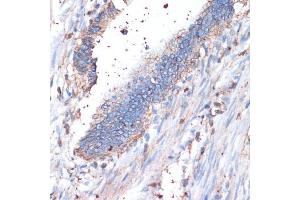 Immunohistochemistry of paraffin-embedded human colon carcinoma using CD44 antibody (ABIN3021912, ABIN3021913, ABIN3021914 and ABIN6217536) at dilution of 1:200 (40x lens). (CD44 antibody  (AA 35-300))