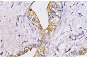 Immunohistochemistry of paraffin-embedded Human lung cancer using Bcl-2 Polyclonal Antibody at dilution of 1:100 (40x lens). (Bcl-2 antibody)