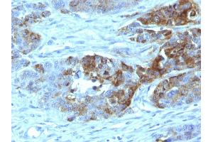 Formalin-fixed, paraffin-embedded human Colon Carcinoma stained with Blood Group Antigen H Type 2 Monoclonal Antibody (19-OLE) (ABO antibody)