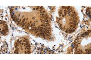 Immunohistochemistry of paraffin-embedded Human colon cancer using COPS5 Polyclonal Antibody at dilution of 1:120 (COPS5 antibody)