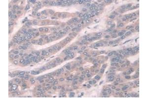 IHC-P analysis of Human Liver Cancer Tissue, with DAB staining. (TPMT antibody  (AA 26-227))