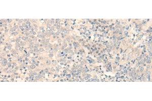 Immunohistochemistry of paraffin-embedded Human cervical cancer tissue using ERP27 Polyclonal Antibody at dilution of 1:35(x200)