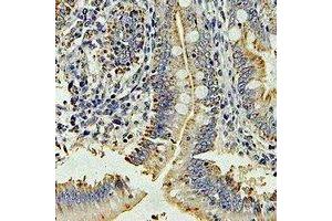 Immunohistochemical analysis of DPP3 staining in human colon cancer formalin fixed paraffin embedded tissue section.