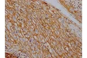 IHC image of ABIN7127819 diluted at 1:100 and staining in paraffin-embedded human liver cancer performed on a Leica BondTM system. (Recombinant ATP1A1 antibody)