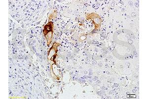 Immunohistochemistry (IHC) image for anti-Carcinoembryonic Antigen Gene Family (CEA) antibody (ABIN722931)