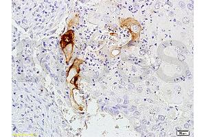 Immunohistochemistry (IHC) image for anti-Carcinoembryonic Antigen Gene Family (CEA) antibody (ABIN722931) (CEA antibody)