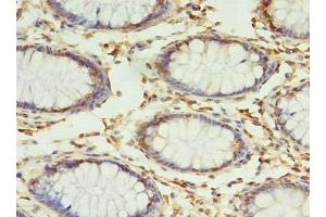 Immunohistochemistry of paraffin-embedded human colon cancer using ABIN7159947 at dilution of 1:100