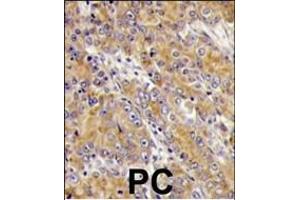 Formalin-fixed and paraffin-embedded human prostata carcinoma tissue reacted with MYO1C antibody (C-term), which was peroxidase-conjugated to the secondary antibody, followed by DAB staining. (Myosin ID antibody  (C-Term))