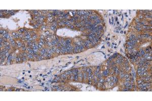 Immunohistochemistry of paraffin-embedded Human colon cancer tissue using MT3 Polyclonal Antibody at dilution 1:50 (MT3 antibody)