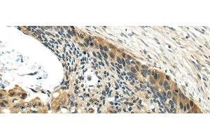 Immunohistochemistry of paraffin-embedded Human esophagus cancer using UBL4A Polyclonal Antibody at dilution of 1/40 (UBL4A antibody)
