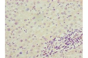 Immunohistochemistry of paraffin-embedded human liver cancer using ABIN7143865 at dilution of 1:100 (ENO1 antibody  (AA 2-428))