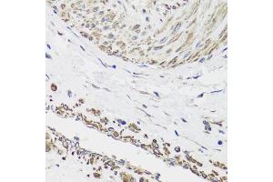 Immunohistochemistry of paraffin-embedded human prostate cancer using DES antibody (ABIN5970272) at dilution of 1/100 (40x lens). (Desmin antibody)