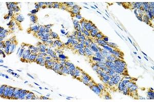 Immunohistochemistry of paraffin-embedded Human colon carcinoma using CYP1A1 Polyclonal Antibody at dilution of 1:100 (40x lens). (CYP1A1 antibody)